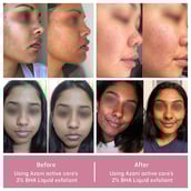 5 - Azani Active Care 2% BHA Liquid Exfoliant,  30 ml  for All Skin Types 